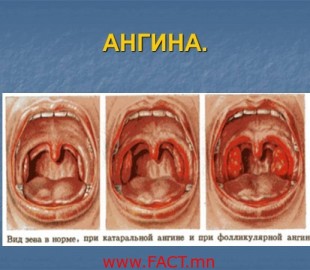 0010-010-Angina-600x450