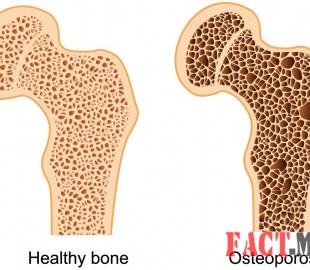 Osteoporosis