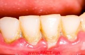 Take-One-Tablespoon-Every-Day-And-Save-Your-Teeth-----Remove-Plaque-In-A-Very-Simple-And-Natural-Way