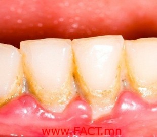 Take-One-Tablespoon-Every-Day-And-Save-Your-Teeth-----Remove-Plaque-In-A-Very-Simple-And-Natural-Way